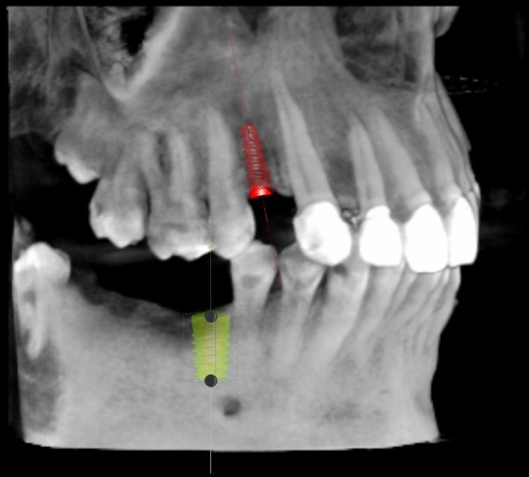 Implanturi dentare