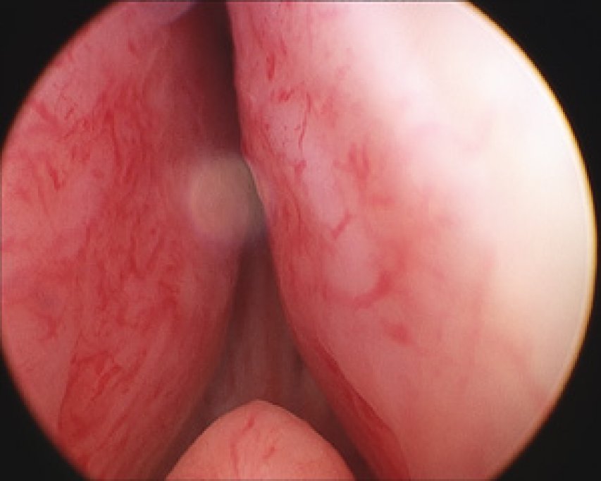 Te poti opera la prostata fara internare - operatia laser pentru prostata
