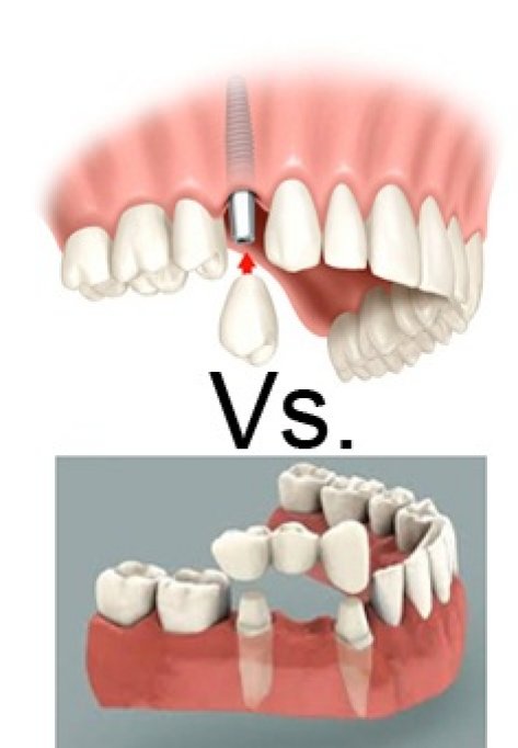 Implant dentar vs. Punte dentara