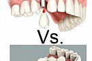 Implant dentar vs. Punte dentara