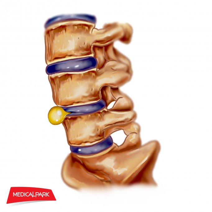 Hernia de disc – cauze şi simptome