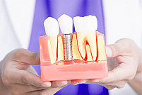 Alegerea intre implant dentar si punte este simpla! Iata de ce!