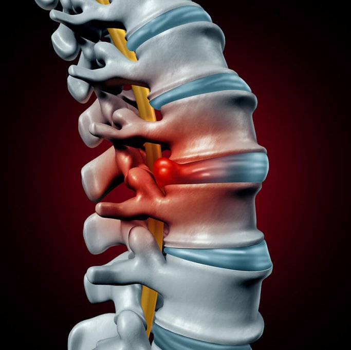 Poti scapa de durerile cauzate de hernia de disc fara operatie