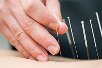 Descopera beneficiile tehnicilor orientale de medicina cu o programare la acupunctura in Bucuresti