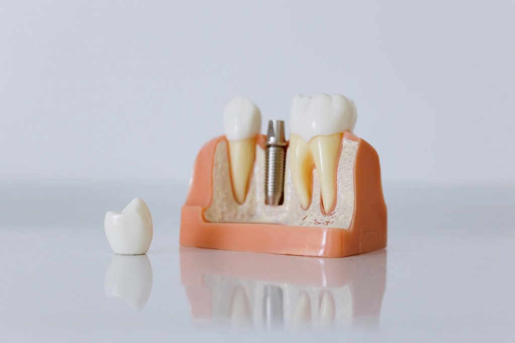 Top 3 factori care influenteaza costurile implanturilor dentare