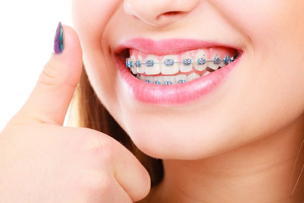 Aparat dentar Incognito - Invizibil si fara durere