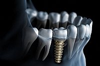 Care sunt avantajele implantului dentar?