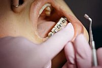 Aparatul dentar: de cate tipuri e și ce trebuie sa știi despre el