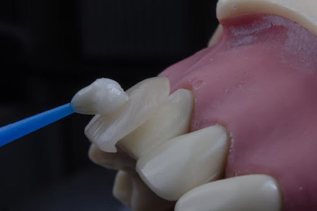 Ce sunt fațetele dentare și când sunt acestea indicate?