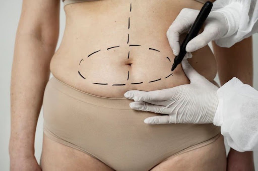 Când să recurgi la liposucție abdominală? Indicații și beneficii ale intervenției