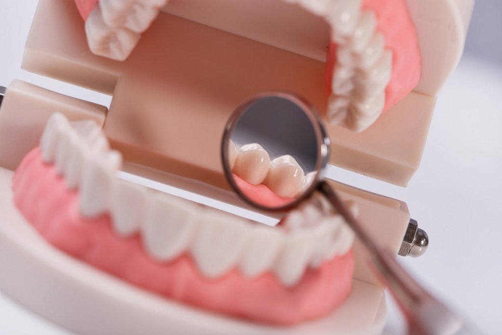 Cum să NU mai faci carii dentare