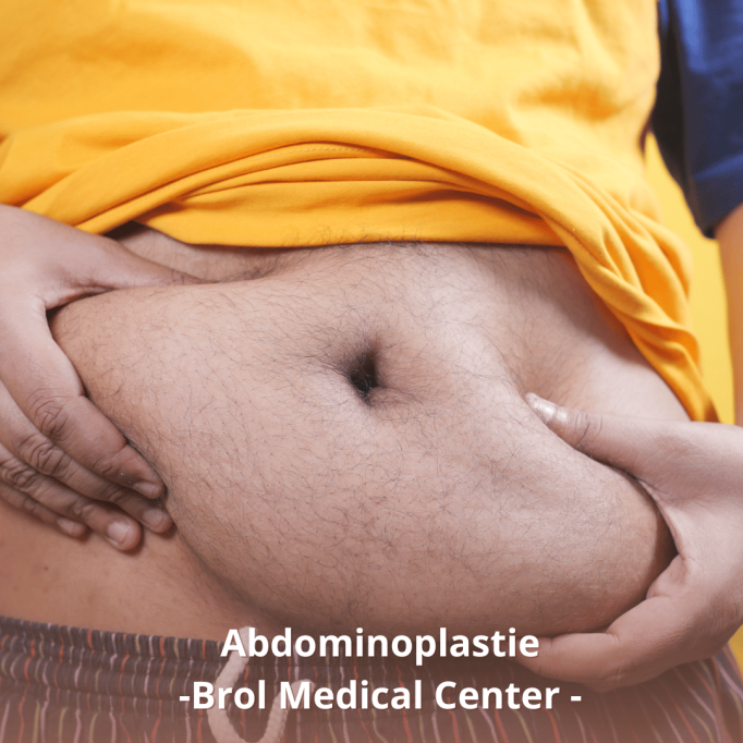Impactul abdominoplastiei