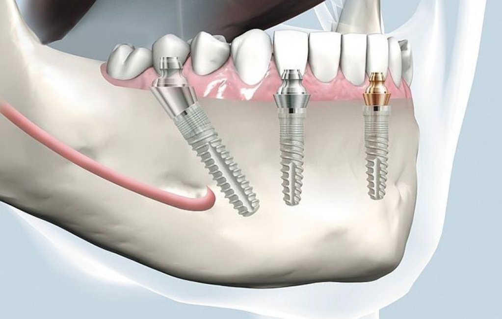 10 avantaje ale implantului dentar Fast and Fixed