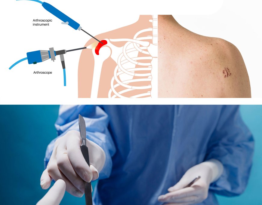 Artroscopia umărului vs. chirurgie: care procedură este recomandată