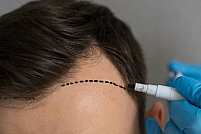 Căderea părului și Alopecia Androgenetică: cauze, tratamente și sfaturi
