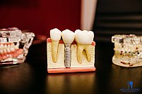 Recapătă încrederea de a zâmbi cu ajutorul implanturilor dentare Bredent de la Implant Studio