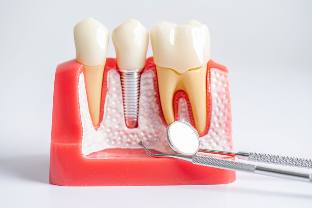 Implantul dentar în cazul pacienților cu diabet