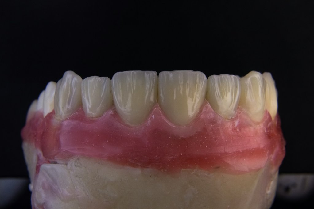 Protetica maxilo-faciala: ce este si cand poti apela la aceasta?