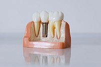 Cum alegi cel mai bun implant dentar pentru tine