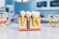 Ce e mai bine pe termen lung: implant sau punte dentară în 2026? Ce alegi pentru un rezultat stabil în timp?
